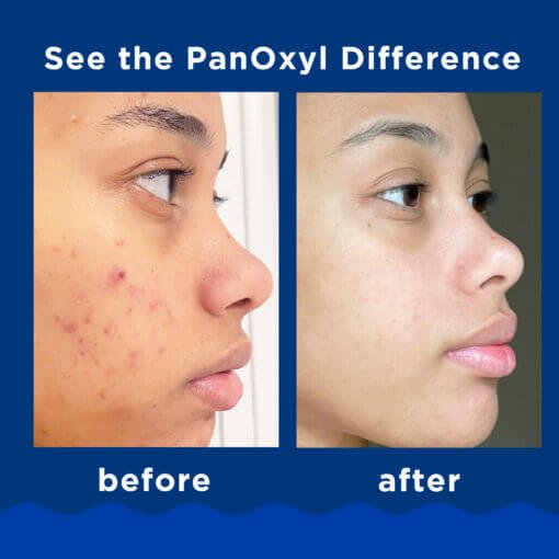 PanOxyl Acne Foaming Wash Benzoyl Peroxide 10% Maximum Strength 170gm